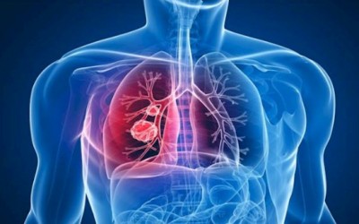 24 de março: Dia Mundial da Tuberculose
