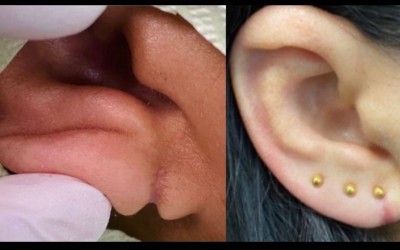 Lobuloplastia sem cirurgia: entenda como funciona o procedimento que não requer anestesia e nem sutura